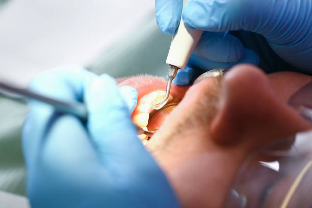 Best Knocked-Out Tooth (Avulsed Tooth) Treatment in Fort Plain, NY